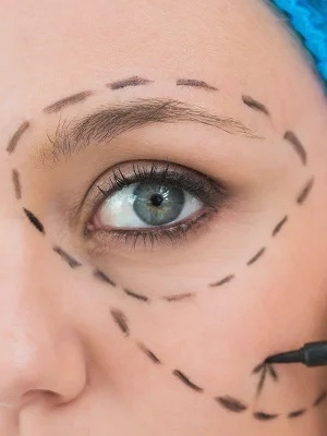 HILOS PDO Periocular