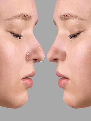 ÁCIDO Hialurónico - Rinomodelación