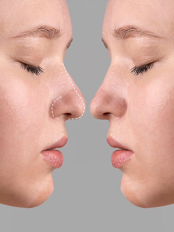 ÁCIDO Hialurónico - Rinomodelación